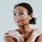 Vitiligo: Comprehensive Guide to Symptoms and Treatment