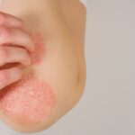 Comprehensive Guide to Dyshidrotic Eczema