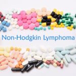 Non-Hodgkin’s Lymphoma: Comprehensive Guide