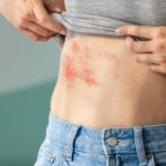 Zosteriform Rash: Comprehensive Guide to Symptoms and Treatment