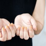 Yellow Nail Syndrome: Comprehensive Guide