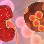 Complete Guide to Kidney Infection