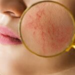 Rosacea: Comprehensive Guide to Symptoms and Treatment