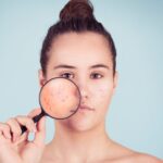 Complete Guide to Acne: Causes, Treatments, and Prevention