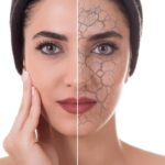 Xerosis (Dry Skin): Comprehensive Guide to Relief